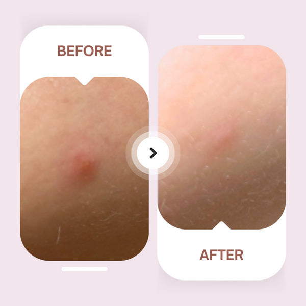 Spotted Daytime Invisible Hydrocolloid Pimple Patches | Maskeraide | boogie + birdie